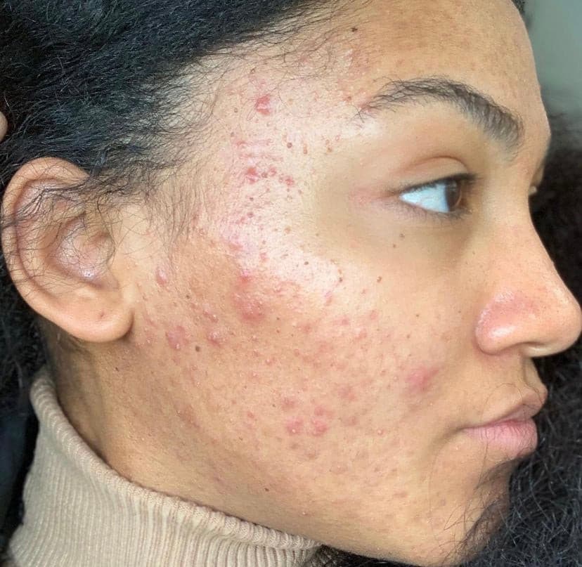 Close-up of a person with acne and blemishes, highlighting skin texture.
